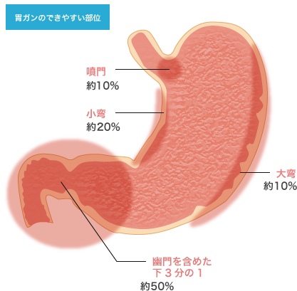 胃がん