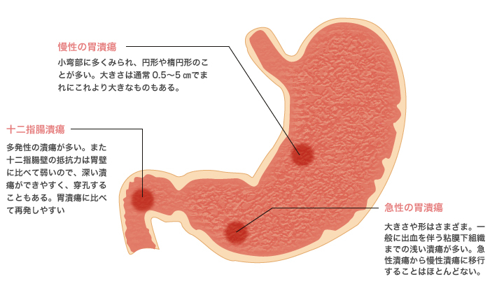 十二指腸 潰瘍 症状