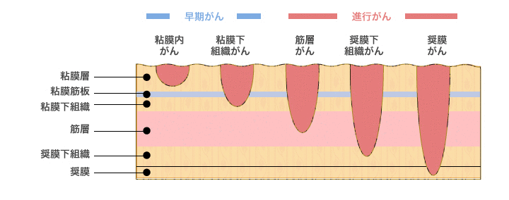 胃がん