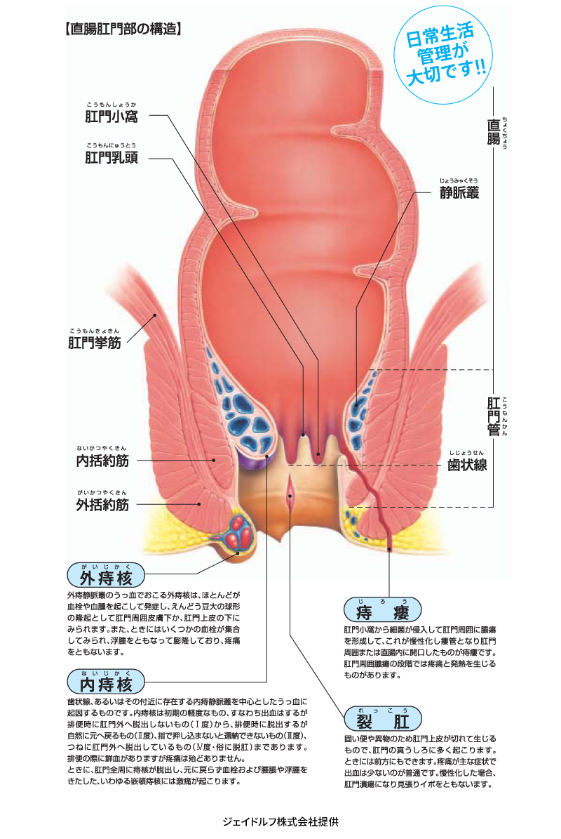 痔のポスターA4